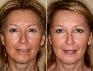 Cele mai eficiente tratamente faciale antirid - Doctor SKiN