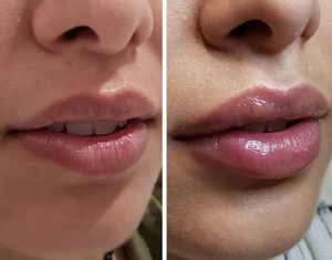 Buze cu acid hialuronic