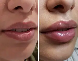 Buze cu acid hialuronic