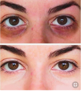 Cum poți scăpa definitiv de cearcăne - Doctor SKiN