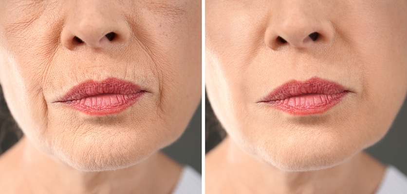 Biorevitalizarea de nouă generație - ultima inovație în materie de hidratare - Skin MedSpa