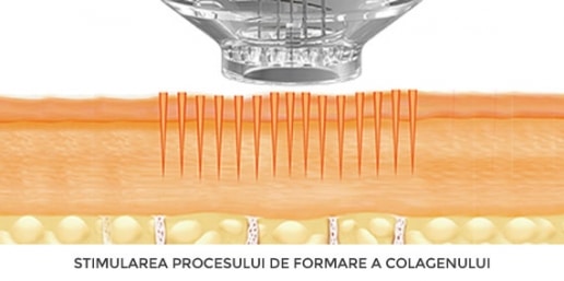 Mezoterapie prin electroporaţie EPN - Skin MedSpa Electroporatie si stimulare de colagen