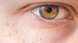 Punctele de grăsime (Milia)