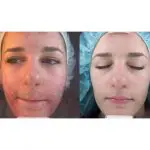 peeling Jessner acnee
