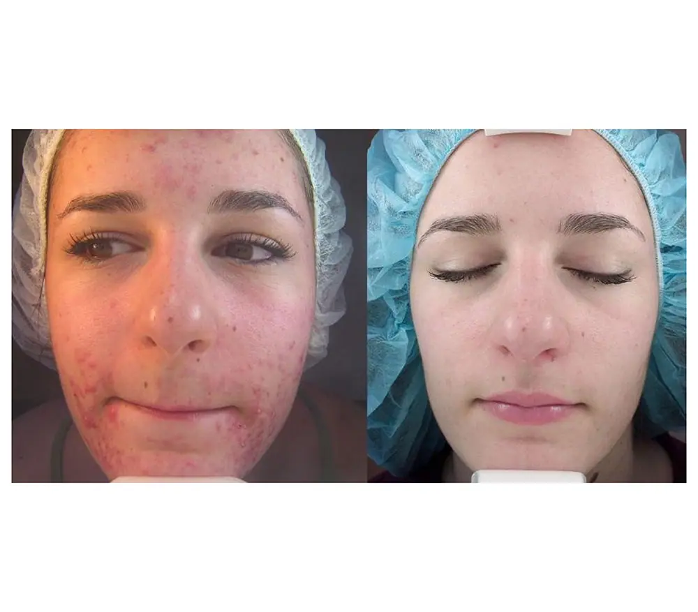 Peeling chimic medical cu Melaspeel J și J2 - Doctor SKiN peeling Jessner acnee