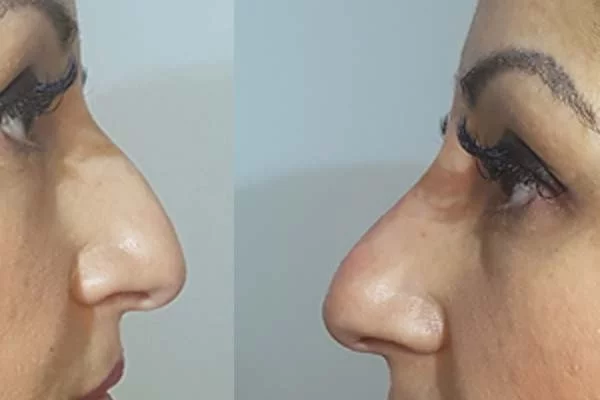 Rinoplastie fără bisturiu - Doctor SKiN
