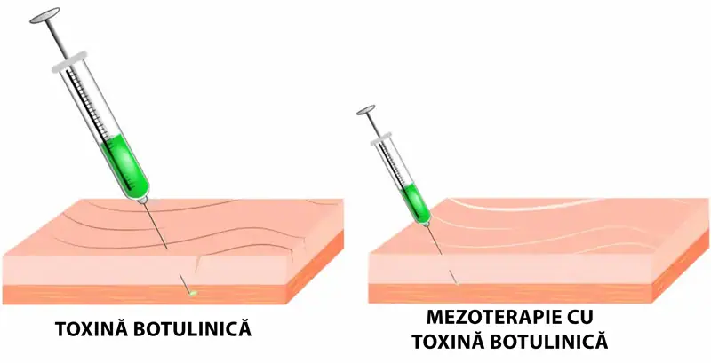 Mezoterapia cu toxină botulinică pentru riduri, pori dilatați, ten gras - Doctor SKiN