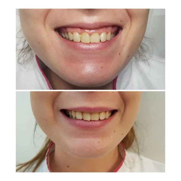 Corectarea zâmbetului gingival cu toxină botulinică - Doctor SKiN
