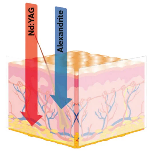 Epilare definitivă cu laserul medical AvalancheLase® Fotona - Doctor SKiN