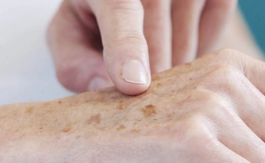 Lentigo și lentigine - Doctor SKiN Lentigo și lentigine - Doctor SKiN