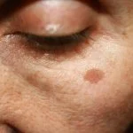 Lentigo și lentigine - Doctor SKiN