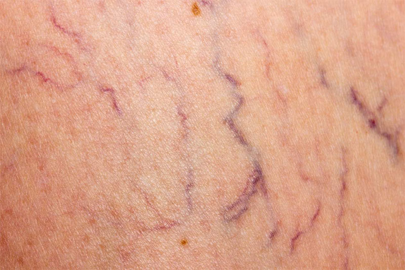 Tratament laser leziuni vasculare, cuperoză, rozacee, onicomicoză - Doctor SKiN