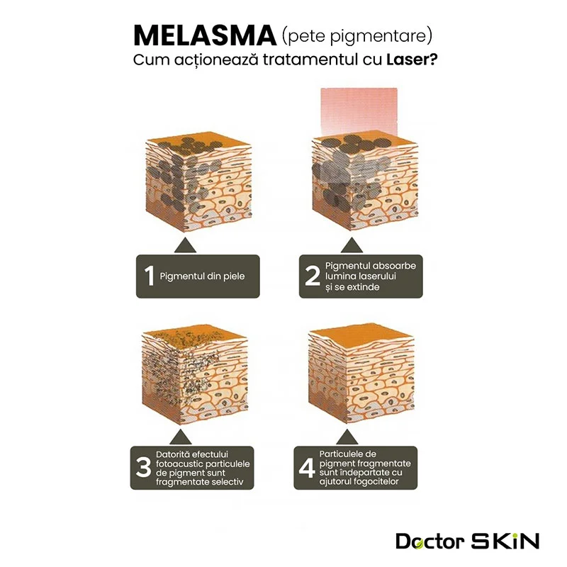 Melasma și hiperpigmentarea - Doctor SKiN