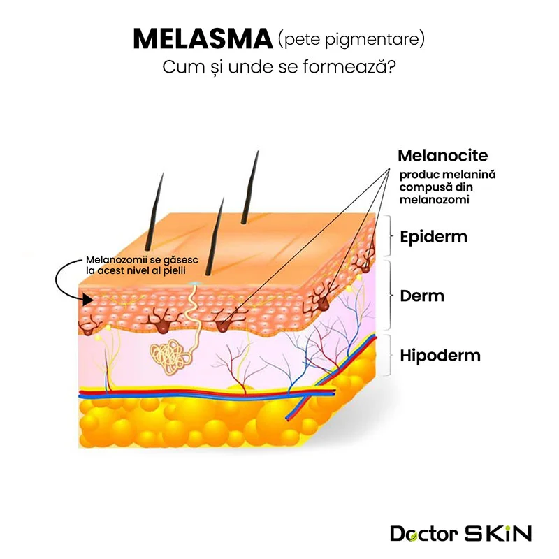 Melasma și hiperpigmentarea - Doctor SKiN