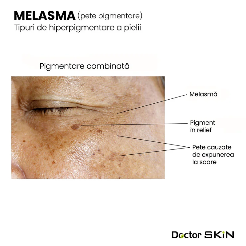 Melasma și hiperpigmentarea - Doctor SKiN