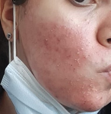 Ce trebuie să știi despre Skin Purging? - Doctor SKiN