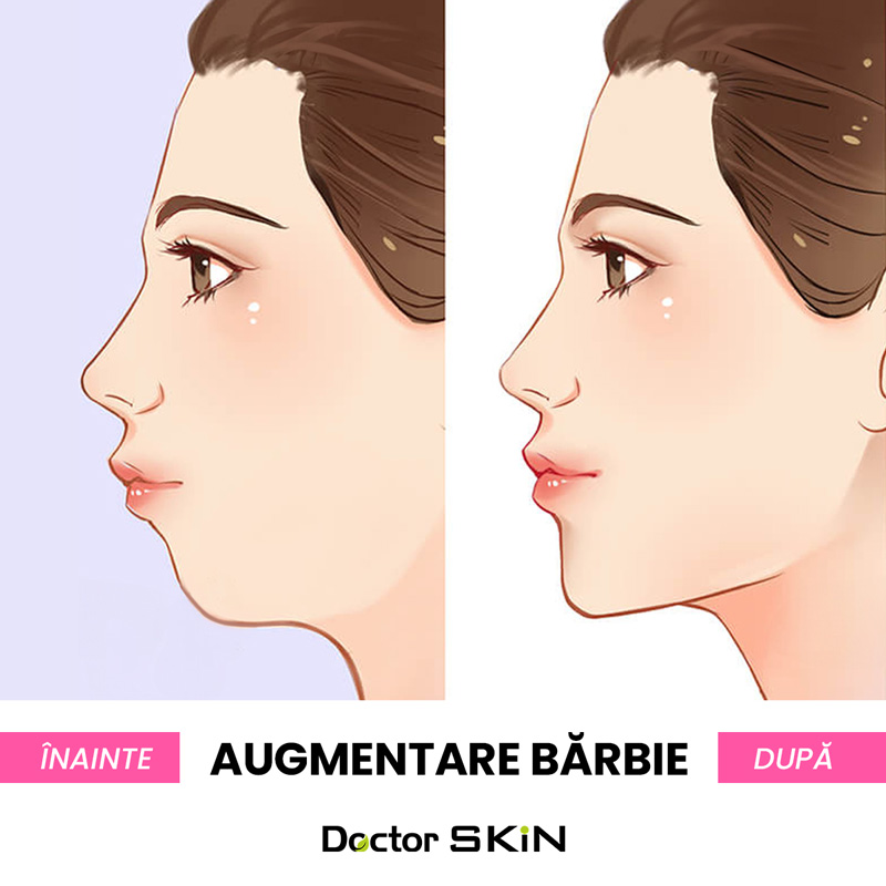 Augmentare Barbie cu acid hialuronic Doctor Skin Bucuresti