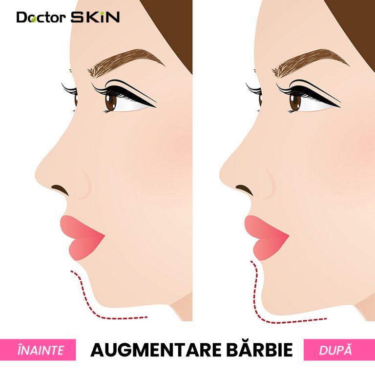 Augmentare menton cu acid hialuronic Doctor SKIN Bucuresti