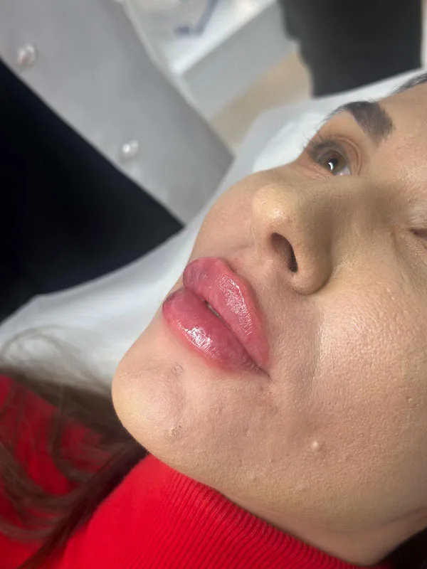 Mărire buze - Doctor SKiN