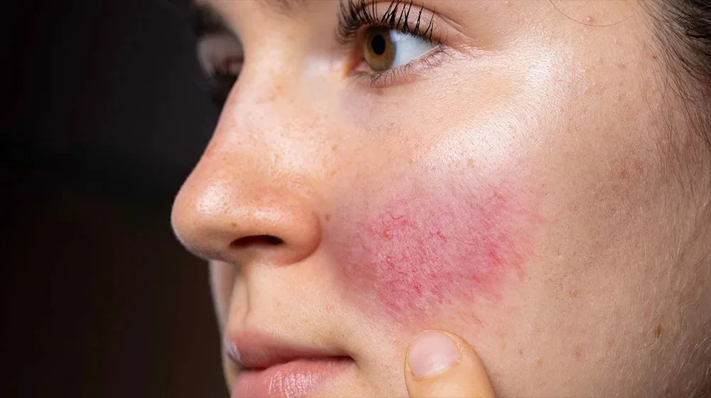 Diferența dintre cuperoză și rozacee: Cauze, simptome și soluții reale pentru o piele fără roșeață! - Doctor SKiN