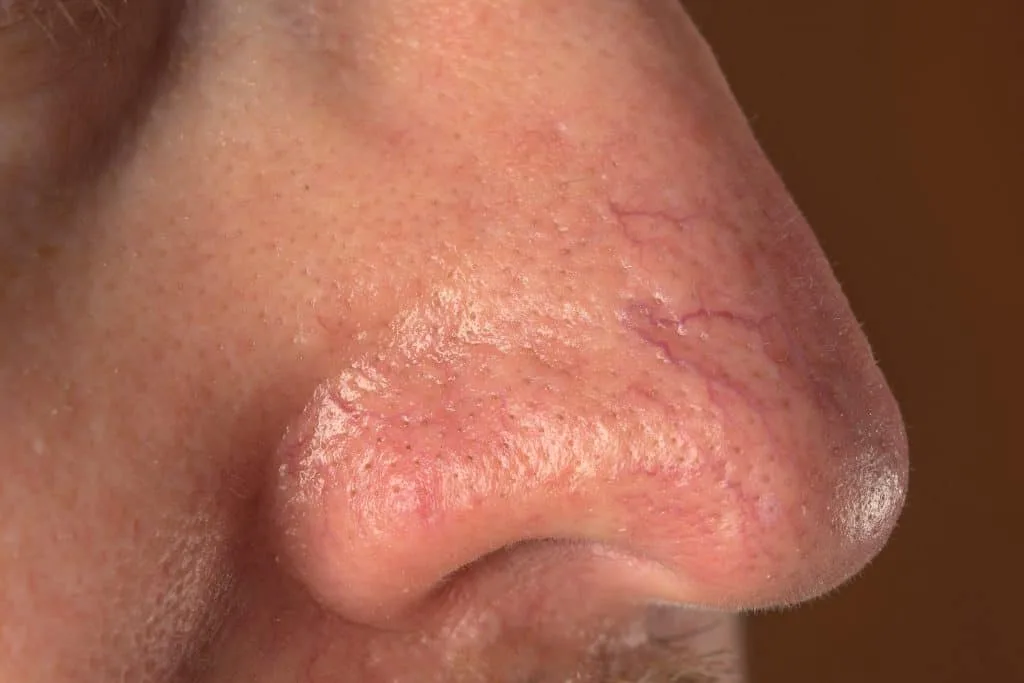 Capilare sparte: Ce să faci ca să dispară? Află opțiunile de tratament care funcționează! - Doctor SKiN Capilare sparte: Ce să faci ca să dispară? Află opțiunile de tratament care funcționează! - Doctor SKiN