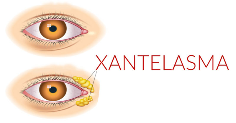 Tratament Xantelasme: Ce sunt depozitele galbene de pe pleoape și cum le poți trata? - Doctor SKiN