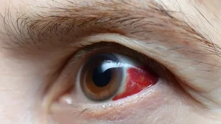 Capilare sparte: Ce să faci ca să dispară? Află opțiunile de tratament care funcționează! - Doctor SKiN Capilare sparte: Ce să faci ca să dispară? Află opțiunile de tratament care funcționează! - Doctor SKiN