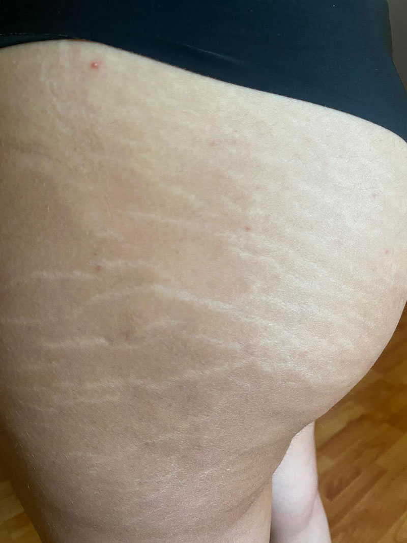 Oferte - Doctor SKiN Laser CO2 vergeturi albe