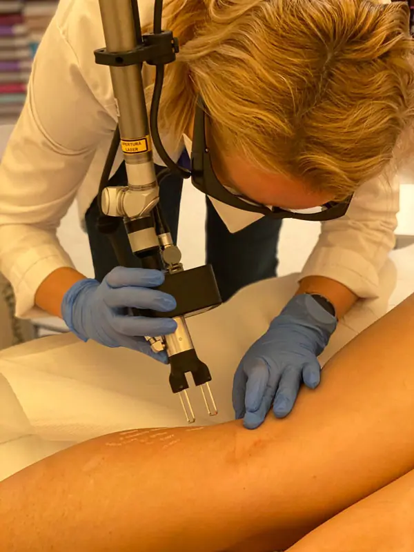 Estompare vergeturi - Doctor SKiN