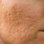 Tratament Cicatrici cu PB serum - Doctor SKiN