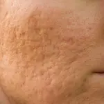 Tratament Cicatrici cu PB serum - Doctor SKiN