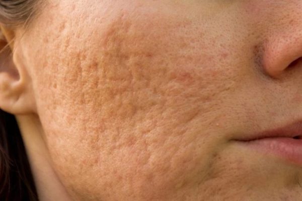 Tratament Cicatrici cu PB serum