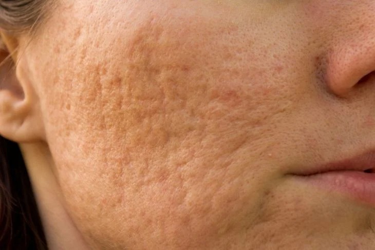 Tratament Cicatrici cu PB serum - Doctor SKiN