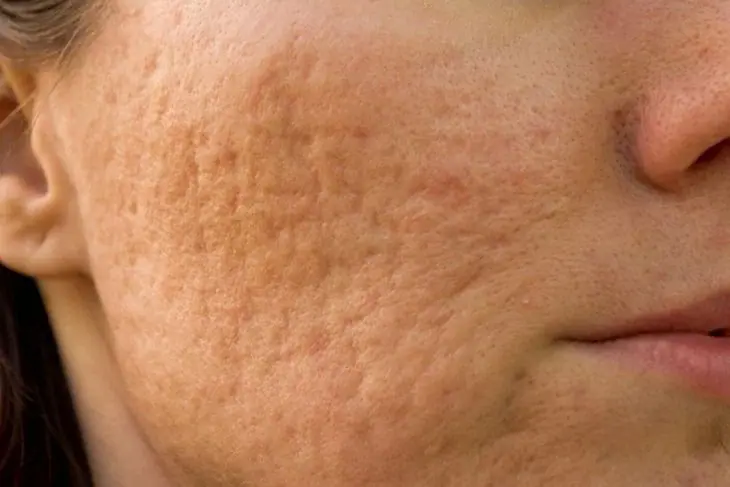 Tratament Cicatrici cu PB serum - Doctor SKiN