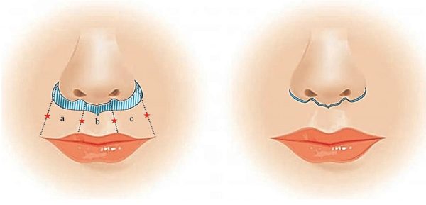Lip lift operație