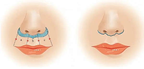 Lip lift operație