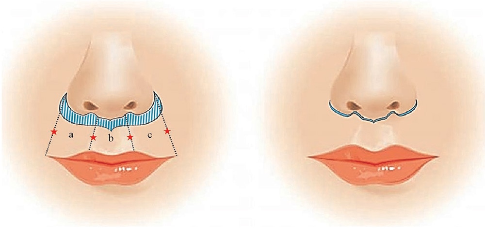 Lip lift operație