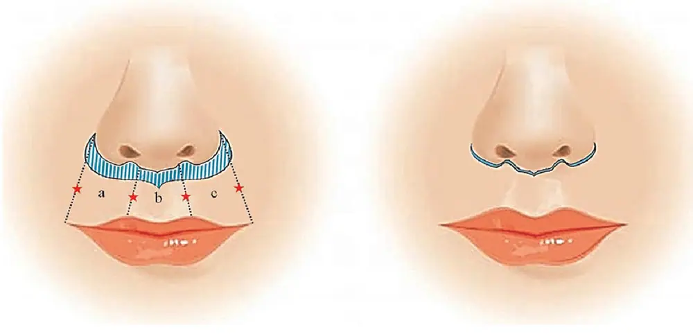 Lip lift operație