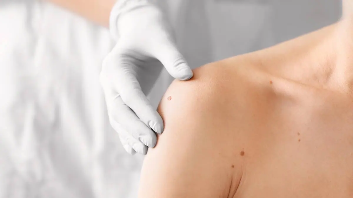 Scoaterea alunițelor cu laser sau prin excizie chirurgicală? Cum alegi corect și sigur pentru pielea ta! - Doctor SKiN
