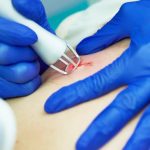 Intervenții chirurgicale dermatologice cu Laser CO2 - Doctor SKiN