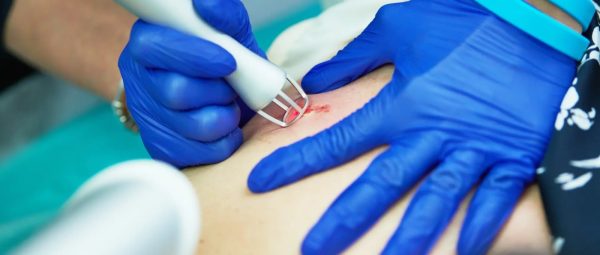 Intervenții chirurgicale dermatologice cu Laser CO2