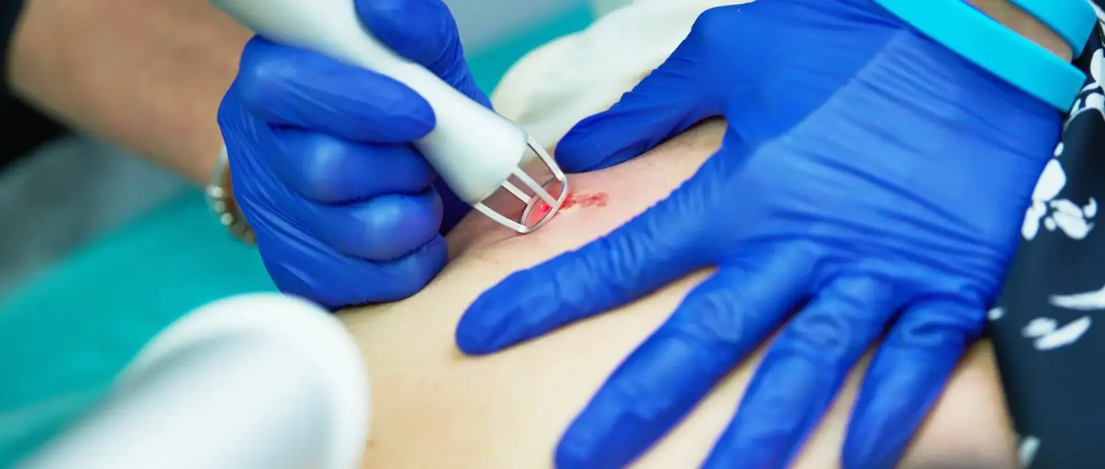 Intervenții chirurgicale dermatologice cu Laser CO2 - Doctor SKiN