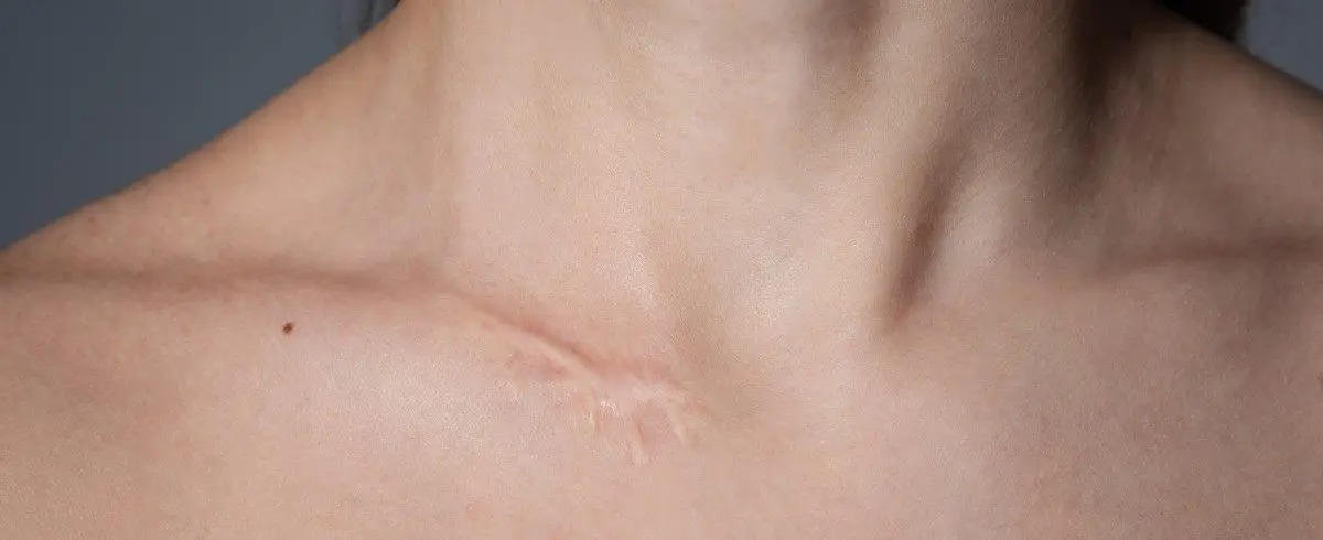 Cicatricile cheloide și cicatricile atrofice: cauze, diferențe și tratamente eficiente pe termen lung - Doctor SKiN