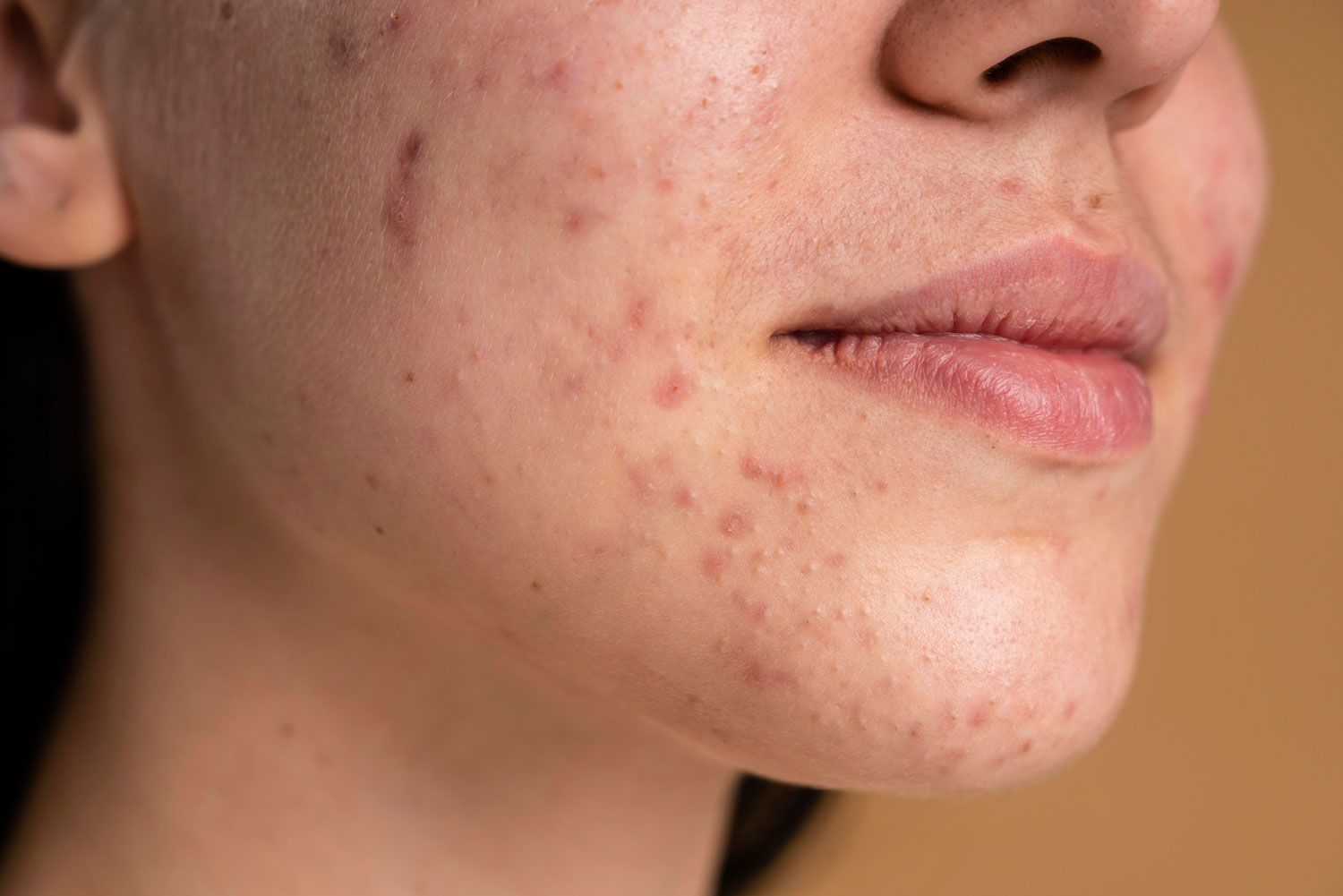 Acneea chistică – ce opțiuni ai când nimic nu pare să mai funcționeze?