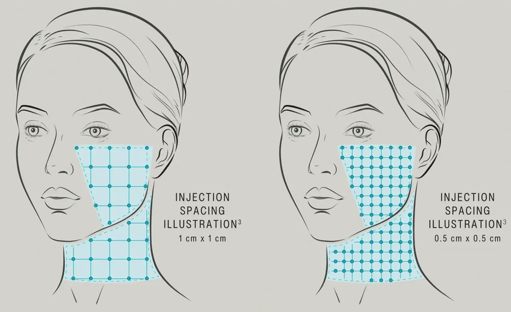 Acid hialuronic SKINVIVE™ by JUVÉDERM®, Skin Booster pentru calitatea pielii (ten hidratat, luminos) - Doctor SKiN Acid hialuronic SKINVIVE™ by JUVÉDERM®, Skin Booster pentru calitatea pielii (ten hidratat, luminos) - Doctor SKiN