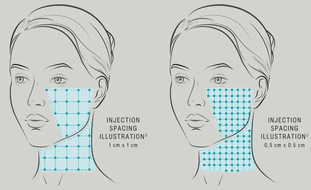 Acid hialuronic SKINVIVE™ by JUVÉDERM®, Skin Booster pentru calitatea pielii (ten hidratat, luminos) - Doctor SKiN