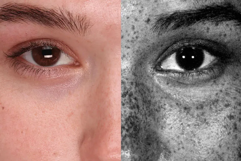 examinarea pielii cu lampa Wood