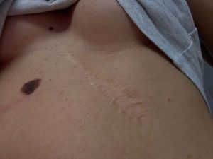 laser cicatrice veche dupa operatie