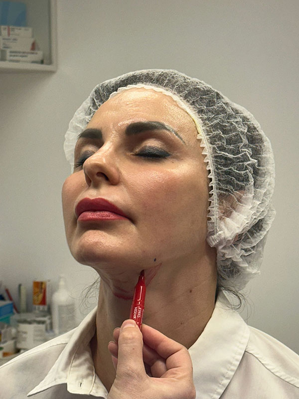 Lifting facial cu fire Aptos - Doctor SKiN Lifting facial cu fire Aptos - Doctor SKiN