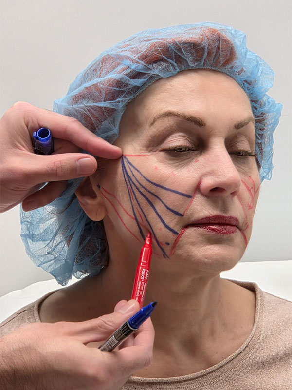 Lifting facial cu fire Aptos - Doctor SKiN Lifting facial cu fire Aptos - Doctor SKiN